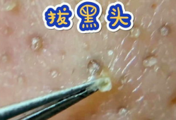粉刺视频
